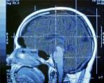 Close-up of an MRI scan of the human brain